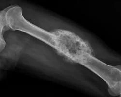 Dolor e inflamación persistentes en los huesos pueden alertar sobre tumores óseos